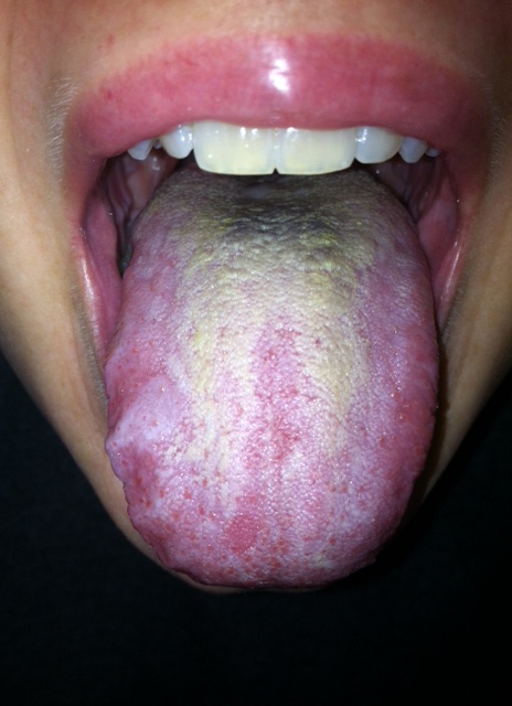 tongue thrush pictures
