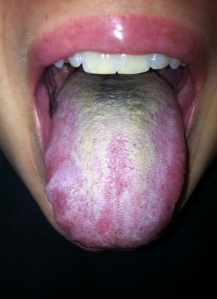 Oral Thrust Candida Fungus